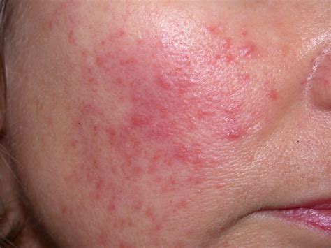 Facial Rashes: What’s the Diagnosis?