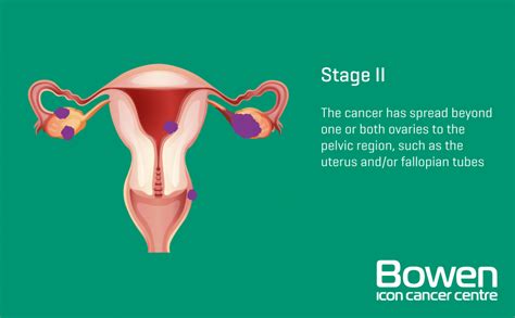 What is Ovarian Cancer? Ovarian Cancer Explained — Bowen Icon Cancer Centre