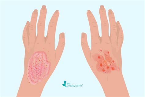 Eczema vs Psoriasis: What’s the Difference?