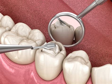 Sealing Vs. Filling Cavities: What's The Difference? | Acorn Dentistry ...