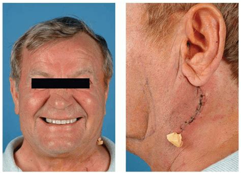 Extracapsular Dissection of Parotid Tumors | Ento Key