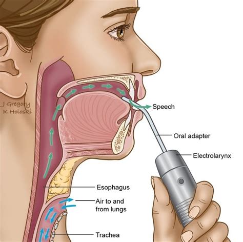 Facts and Information on Laryngeal Cancer - IMU University Malaysia