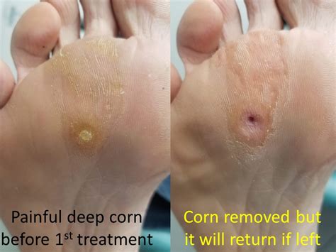 Corn Foot Removal Video at Amanda Owens blog