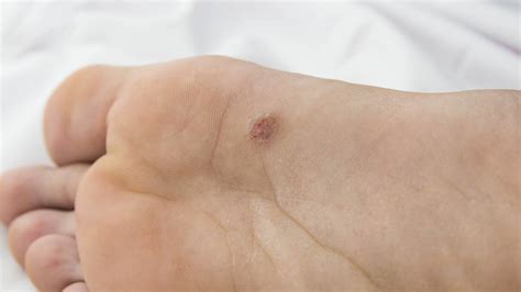 Plantar Wart Stages of Healing: A Comprehensive Guide - MyHealthGeek