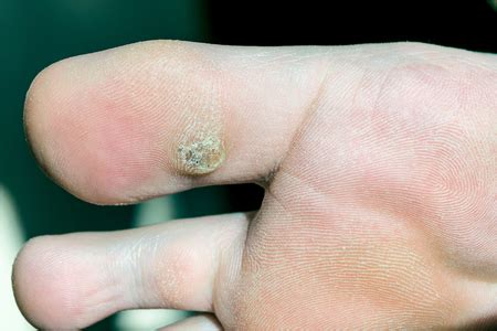 Plantar Warts Can Be Very Painful — PodiatryCare, P.C. and the Heel ...