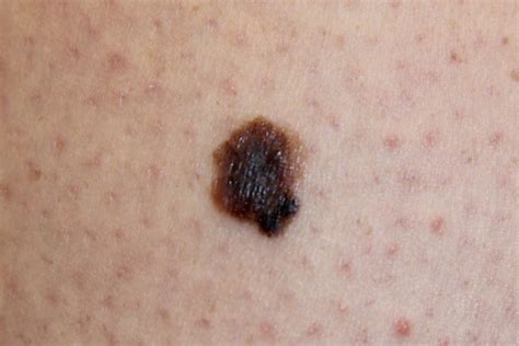 Early Malignant Melanoma Skin Cancer