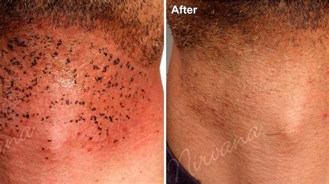 Brazilian Laser Hair Removal Before And After Photos - Hair Style Blog