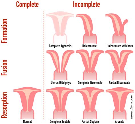 Four Tips for Correctly Diagnosing Uterine Anomalies