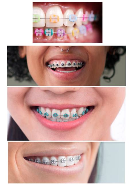 What are the Best Braces Color for You in 2024? - Orthodontic Arts