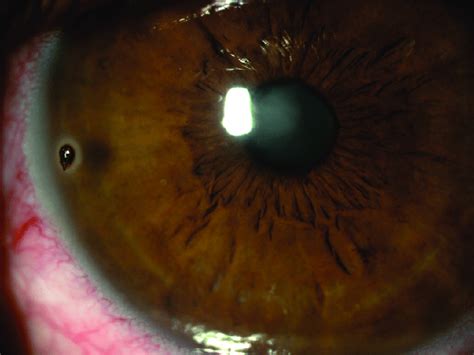 Corneal foreign body. | Download Scientific Diagram