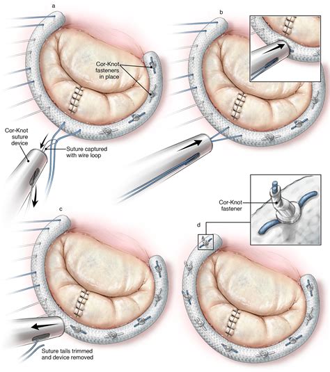 Minimally Invasive and Robot-Assisted Mitral Valve Surgery | Adult and ...