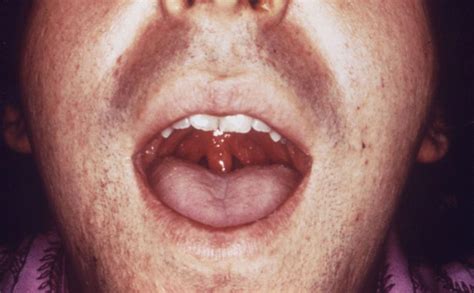 Chlamydia Mouth Sores