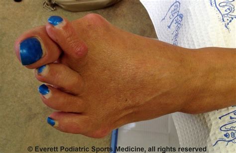 Symptoms of Hammertoes and How to Treat Them - Everett Podiatric Sports ...