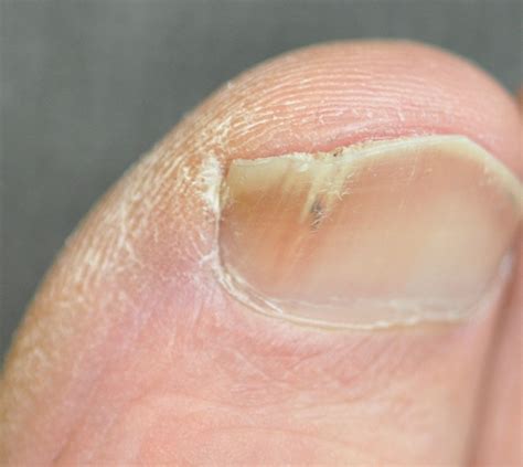 Fungal Nail Infection Prescription Cation - Nail Ftempo