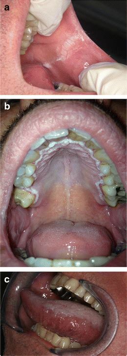 a Hyperkeratotic lesions of the linea alba induced by a BRAF inhibitor ...