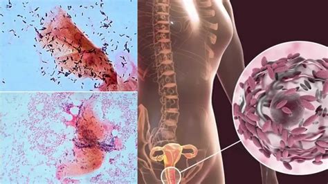 Gardnerella Vaginalis - Habitat, Morphology, Genome, Treatment ...