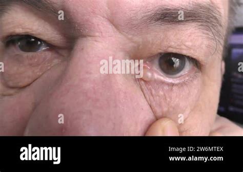 Apocrine hydrocystoma of the eyelid. This is a benign Moll gland cyst ...