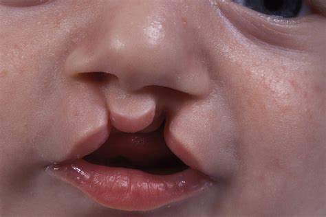 Cleft Lip And Palate Diagram