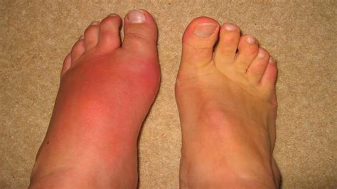 Gout | Gout causes | How to treat gout | Home Remedies for Gout - YouTube