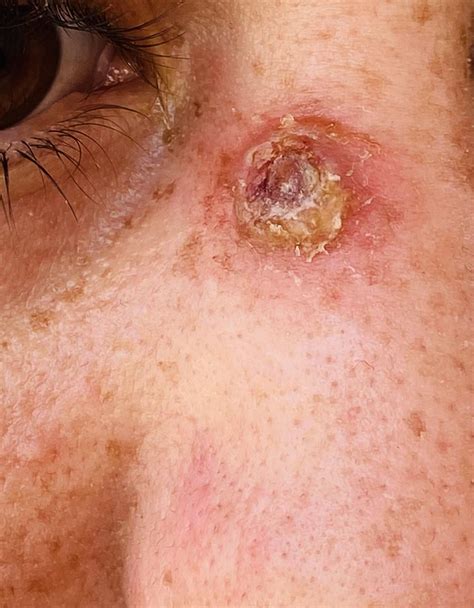 Possible infected pimple : r/acne