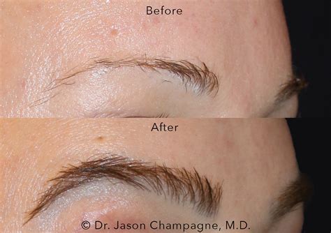 Permanent Eyebrow Enhancement — Plastic Surgeon Beverly Hills, CA | Dr ...