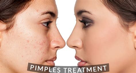 Best Pimple Treatment in Hyderabad | Dr Venus Skin Clinic