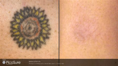 Introducing Laser Tattoo Removal! | Dr Monica Scheel Dermatology ...