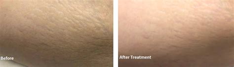 Before And After Pictures Of Laser Treatment For Stretch Marks