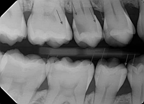 Bitewing xray with cavities 2 | Palms Dentist, Shirley Christchurch ...