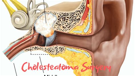 Cholesteatoma surgery - YouTube