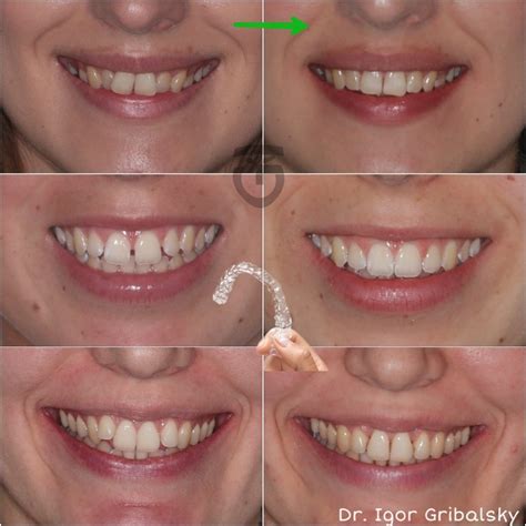 Clear aligners. Straight teeth without braces. Orthodontist Specialist ...