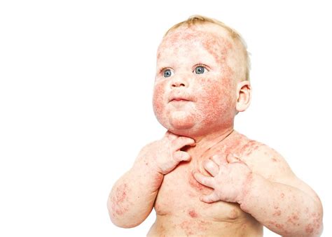 Dermatitis - Atopic : Overview, Causes, Symptoms, Treatment - illness.com