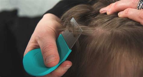 Lice vs. Dandruff: How Do I Tell the Difference?