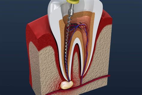 Root canal treatment process. 3D illustration | Hancock Village Dental ...