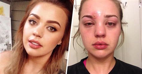 How a popped pimple led to a staph infection