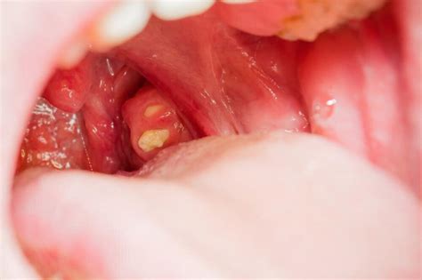 Do Tonsil Stones Cause Bad Breath? - Coburg Dental Group