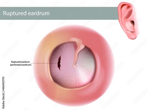 Ruptured eardrum or perforated eardrum. Tympanic membrane perforation ...