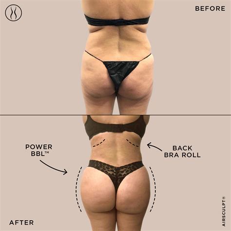 BBL vs. Butt Lift: How They Differ