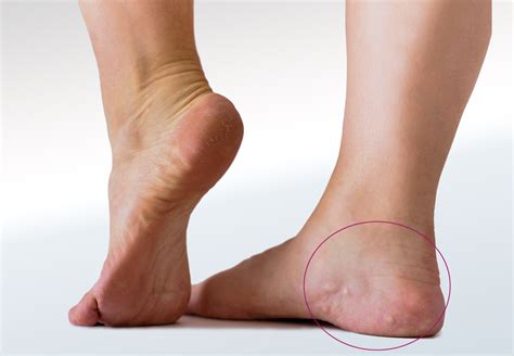 Piezogenic Papules - Relieve Foot Pain & Leg Pain