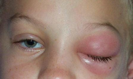 Eye Orbital Cellulitis