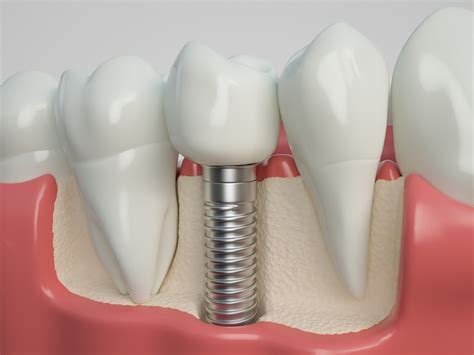 The Three Types of Dental Implants | Merrifield Dental Associates