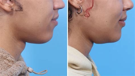 Surgeons Develop Effective Scarless Adam’s Apple Surgery - ScienceBlog.com