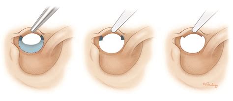 Postauricular Meatoplasty – Oto Surgery Atlas