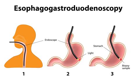 Gastrointestinal Endoscopy - CPM Advanced Surgical Specialists