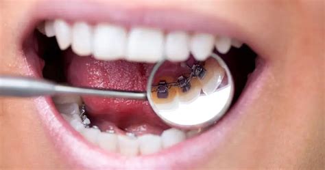 Lingual Braces: Cost, Pros and Cons and Where to Get Them - Dentaly.org