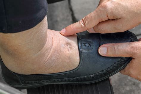 Why You Should Invest In Medical Shoes For Swollen Feet