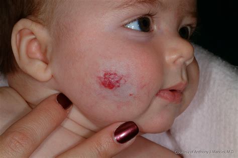 Hemangioma Causes, Identification and Diagnosis | Wiki Itchy Mind