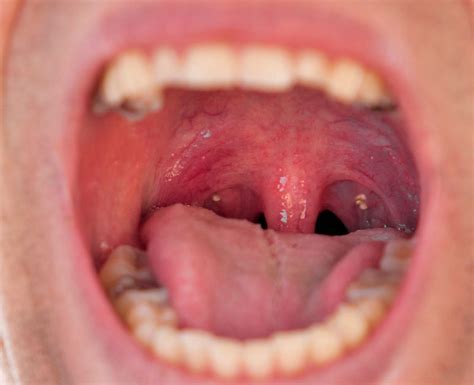 Tonsil Stones: Symptoms, Causes, Removal & Treatment