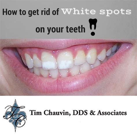 How to get rid of white spots on your teeth - Dr Chauvin