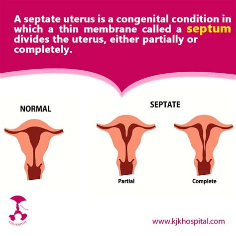 Septate Uterus | Uterus, Infertility treatment, Premature birth